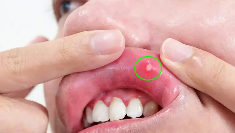 Kanserin Gizli Belirtilerine Dikkat: Dilin Alınması Gereken Zavallı Bir Kadının Hikayesi